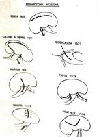 Nephrotomy incisions diagram.